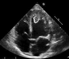 <p>This was taken on a patient who has been diagnosed with postpartum cardiomyopathy and who currently has an ejection fraction of 20%.&nbsp; What is the most likely diagnosis?</p><p></p><p>left atrial myxoma</p><p>&nbsp;</p><p>left mitral valve vegetation</p><p>&nbsp;</p><p>left ventricular thrombus</p><p>&nbsp;</p><p>right atrial myxoma</p>