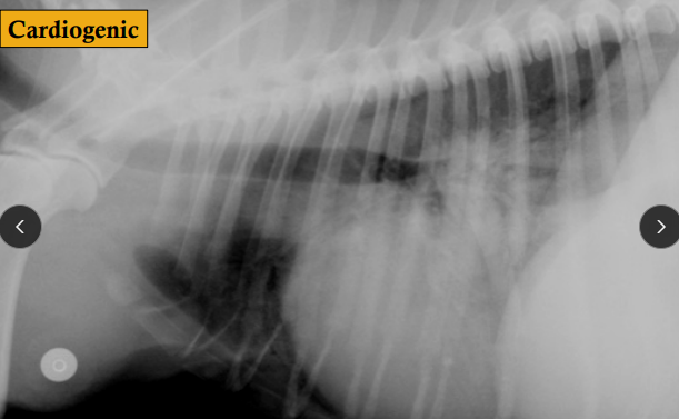 <p><span>Pulmonary Edema</span></p>