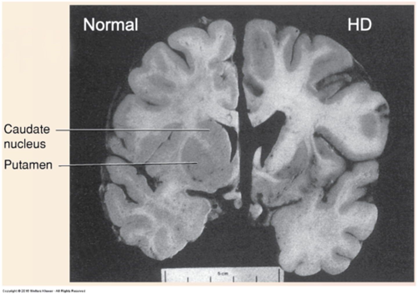 <p>Huntington's disease is rare, hereditary, progressive, fatal - _-_ people per 100,000 with European ancestry, less in other ethnic groups</p>