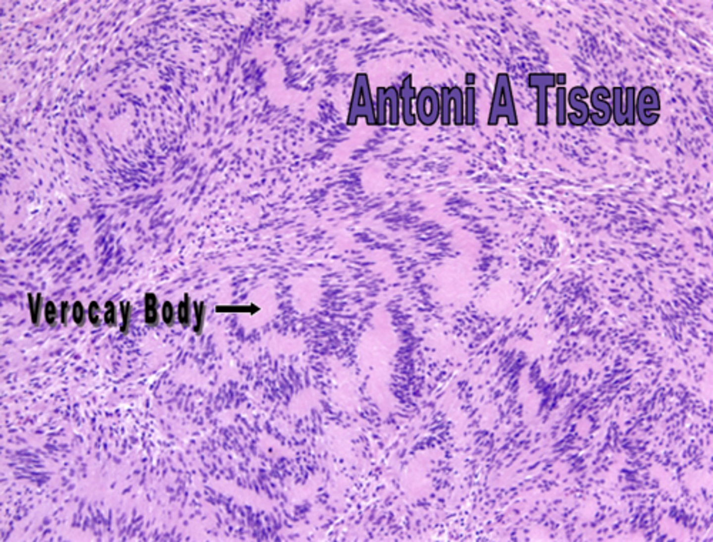 <p>neurilemmoma</p>