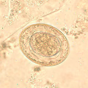 <p><span>The egg shown below may cause infection by hand-to-mouth transfer or by internal autoinfection. This small worm most often infects children, and finding the egg in feces is diagnostic. Identify the parasite.</span></p><p>Ascaris lumbricoides</p><p>Enterobius vermicularis</p><p>Hookworm</p><p>Hymenolepis diminuta</p><p>Hymenolepis nana</p>