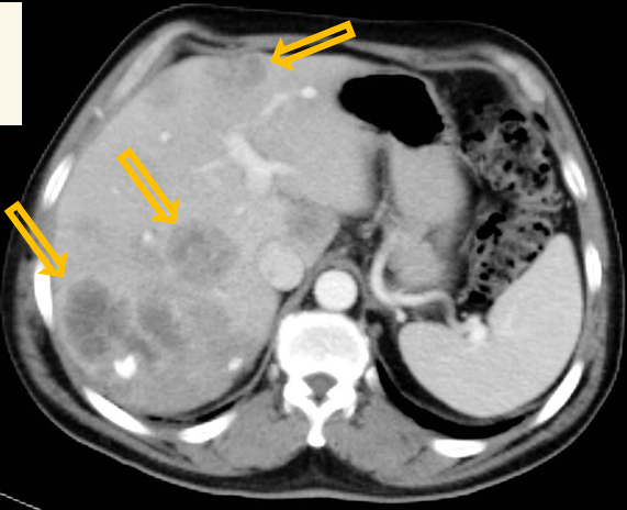 <p>Modality: Region: contrast-enhanced </p><p>CT, portal phase, iv. iodine-based contrast agent upper abdomen, axial view </p><p>Radiologic sign: multiple hypoenhancing lesions of the liver, normal spleen </p><p>Diagnosis: multiple liver metastases (most commonly from colon adenocc.)</p>