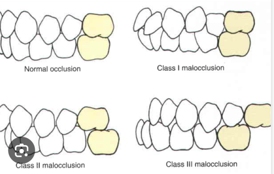 <ul><li><p><strong>Class I occlusion</strong>: Normal anteroposterior relationship of maxillary and mandibular teeth.</p><ul><li><p><strong>Class I malocclusion</strong>: Slightly larger overjet affecting only the incisors.</p></li></ul></li></ul><p></p>