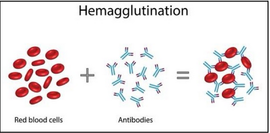 <ul><li><p><span style="background-color: transparent;">The recipient's anti-B antibodies will recognize the B antigens on the donor RBCs. This will cause aggutination (clumping) of the donor RBCs.</span></p></li><li><p><span style="background-color: transparent;">Note that the donor antibodies have little effect unless it’s a large transfusion because the antibodies get diluted.</span></p></li></ul><p></p>