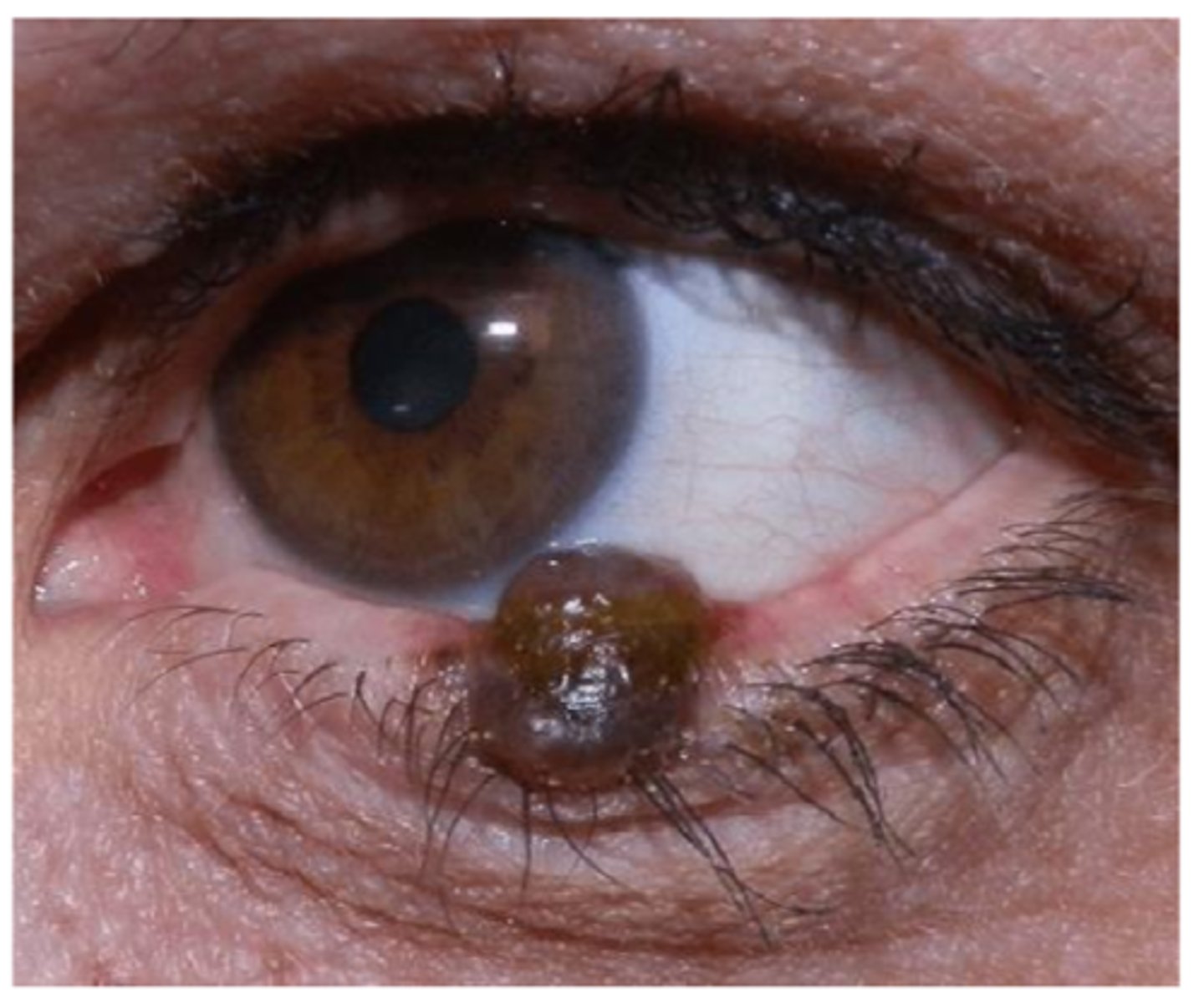 <p>lesion size</p><p>lesion depth</p>