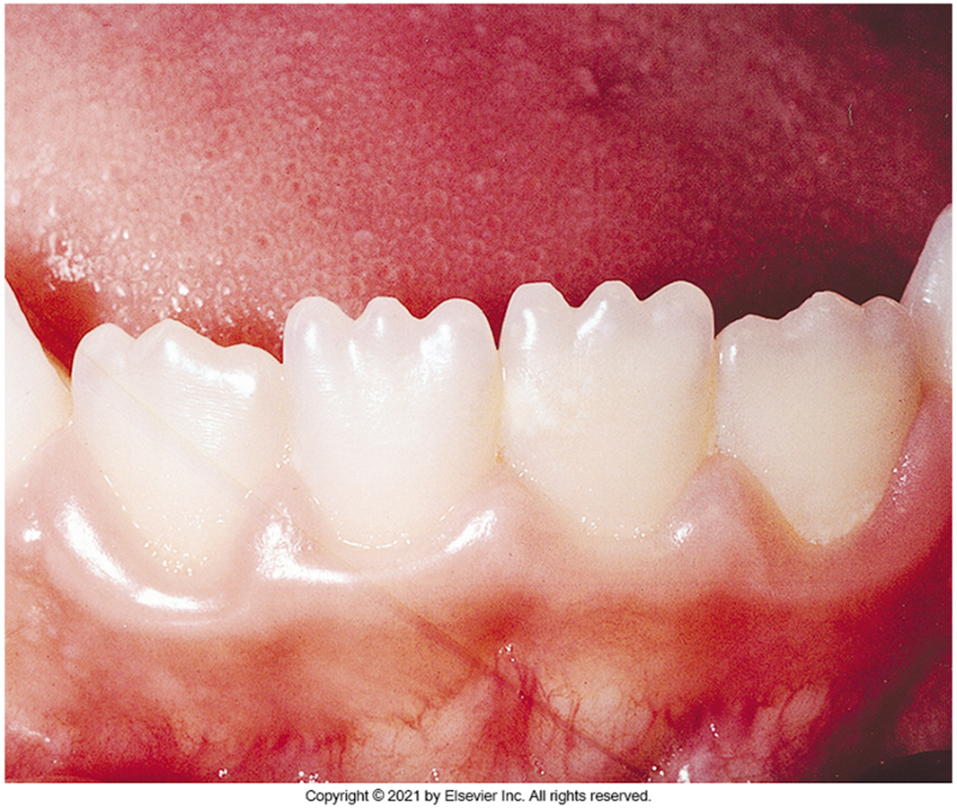 <p><span>three mamelons, or rounded enamel extensions on the incisal ridge. These ridges will disappear over time after wear and occlusion. </span></p>