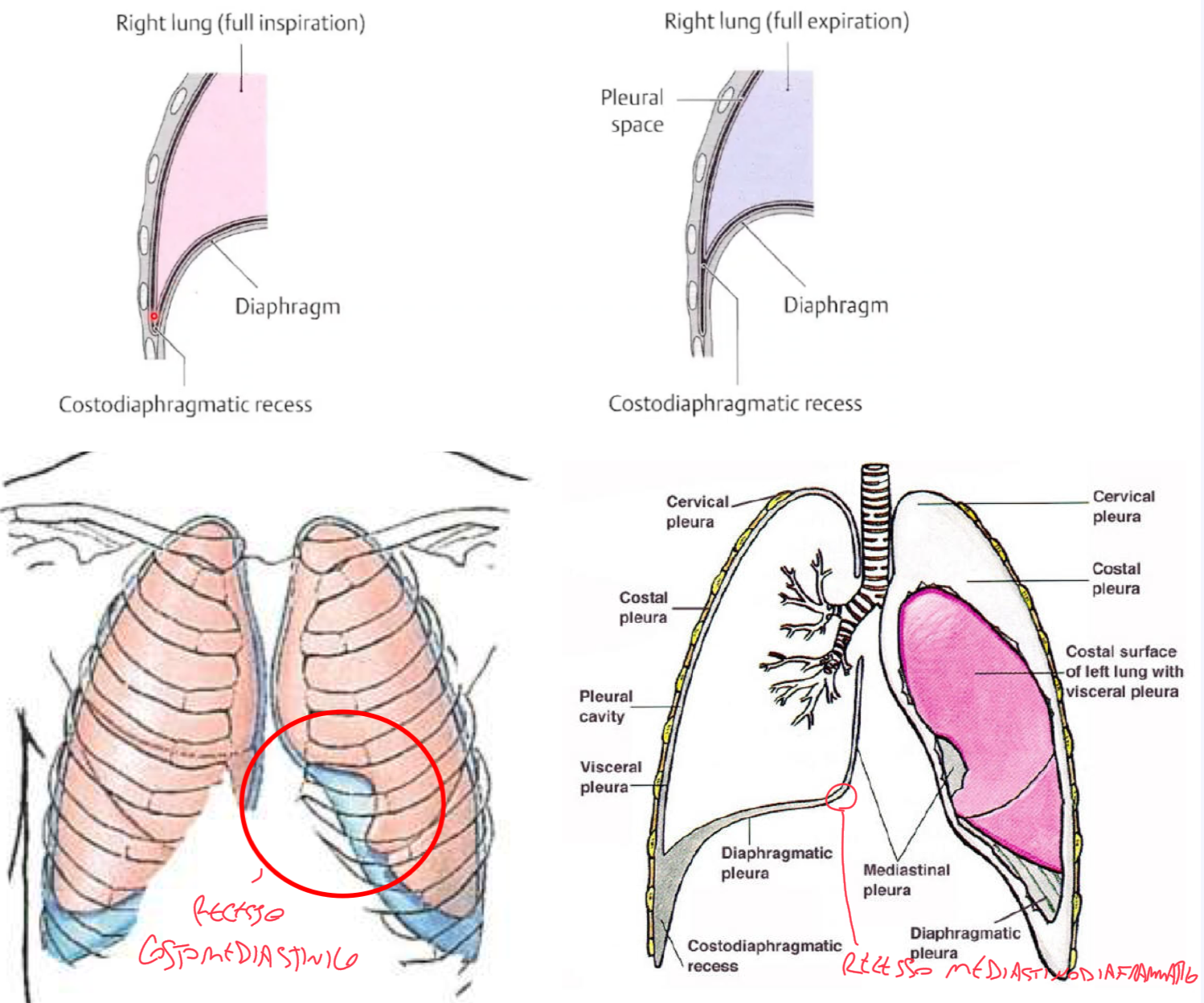 <p>RECESSO COSTODIAFRAMMATICO:</p><ul><li><p>La pleura parietale, seguendo la faccia interna delle pareti del torace, si estende oltre il margine inferiore del polmone e si allontana dalla pleura viscerale</p></li><li><p>Dove la pleura parietale costale si continua con quella diaframmatica si forma il recesso costodiaframmatico che è quello più profondo (5cm).</p></li><li><p>Questo ha un significato clinicamente importante in chirurgia, perché se si incide pensando di essere sotto il polmone, in realtà abbiamo il recesso costodiaframmatico che continua fino la 11-12 costa, e quindi si rischierebbe pneumotorace e collasso del polmone</p></li></ul><p>RECESSO COSTOMEDIASTINICO:</p><ul><li><p>Si forma dal passaggio tra la pleura costale a mediastinica</p></li><li><p>Più ampio a sx per la incisura cardiaca</p></li></ul><p>(tra pleura mediastinica e diaframmatica abbiamo il recesso mediastinodiaframmatico)</p><p></p>