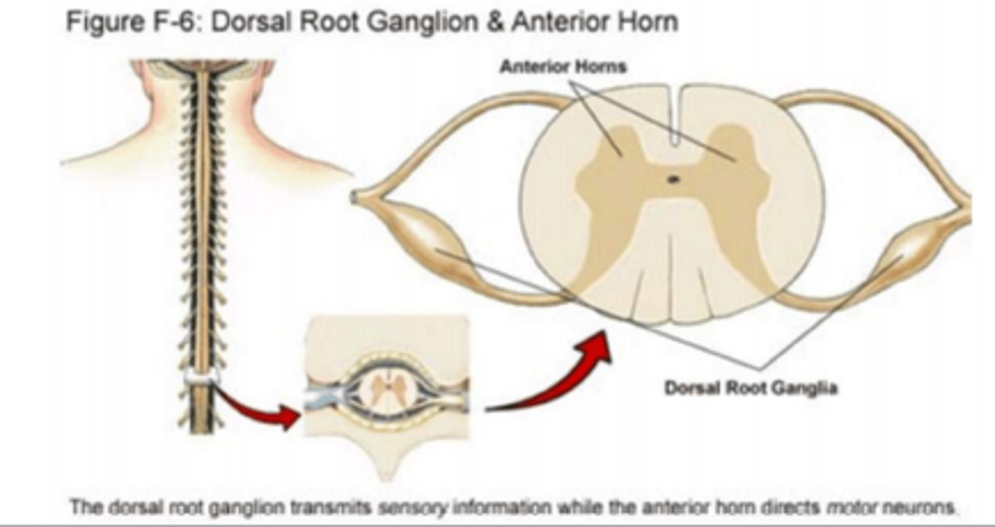 <p>acute onset of flaccid paralysis in one or more limbs</p><p>- may be caused by anterior horn cell infection w wild or vaccine polio virus, or other viruses. eg Enterovirus 71</p><p>anterior horn of spinal cord contains bodies of motor neurons, which put brain's decisions- based on sensory info ( from dorsal root ganglia)- into action. damage to anterior horn cells affects muscle movements</p>