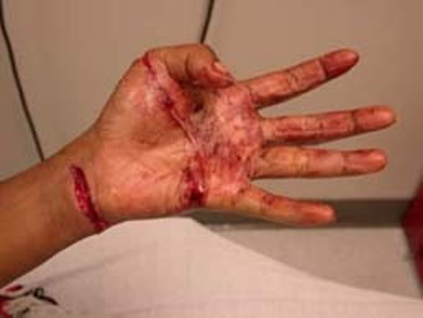 <p>wound that breaks the surface of the skin</p>