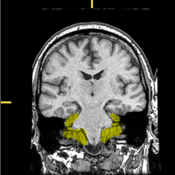 <p>What part of the brain is highlighted?</p>