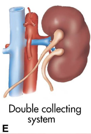 <p><mark data-color="yellow" style="background-color: yellow; color: inherit;">duplex system—2 ureters and 2 renal sinuses</mark></p>