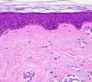 <p>Which one: <strong>Basal Cell Carcinoma</strong> OR <strong>Normal Epithelium</strong></p>