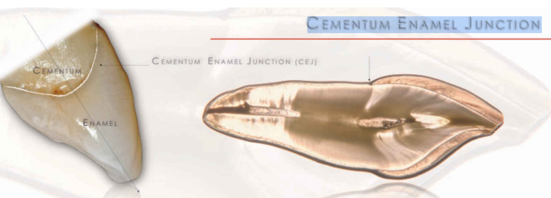 <p><span>the boundary between the enamel (hard outer layer of the tooth) and the cementum</span></p><ul><li><p>60% - 65% ENAMEL AND <span style="background-color: transparent; font-family: Arial, sans-serif, Inter, ui-sans-serif, system-ui, -apple-system, BlinkMacSystemFont, "Segoe UI", Roboto, "Helvetica Neue", "Noto Sans", "Apple Color Emoji", "Segoe UI Emoji", "Segoe UI Symbol", "Noto Color Emoji"; font-size: 1.6rem;">CEMENTUM </span>OVERLAPS</p></li><li><p>30% edge to edge</p></li><li><p>5-10% enamel and cementum dont overlap</p></li></ul><p></p>