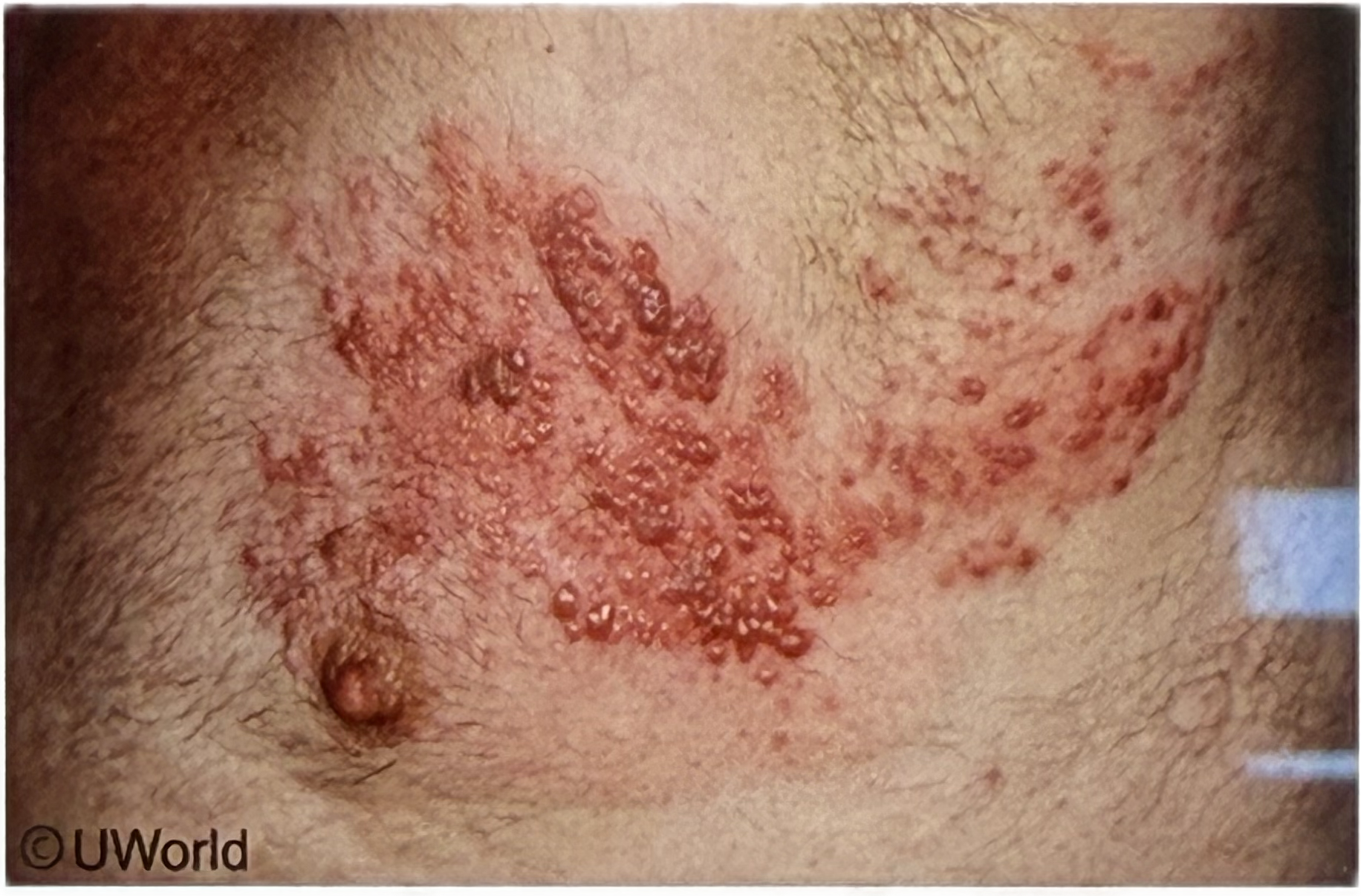 <p><span style="color: rgb(0, 0, 0)">A 61-year-old man with a history of COPD on systemic glucocorticoids presents with a 3-day history of a painful vesicular rash on his torso (shown in the image). Which event most likely immediately preceded the appearance of this rash?&nbsp;</span></p>