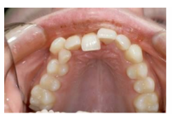 <p><span style="background-color: transparent;"><span>Bodily movement of the tooth within the socket - crown moves in one direction (usually direction of force) and root moves in opposite.</span></span></p><p><span style="background-color: transparent;"><span>Apex displacement - rupture of neurovascular bundle and crushing of PDL cells in palatal cervical region</span></span></p>