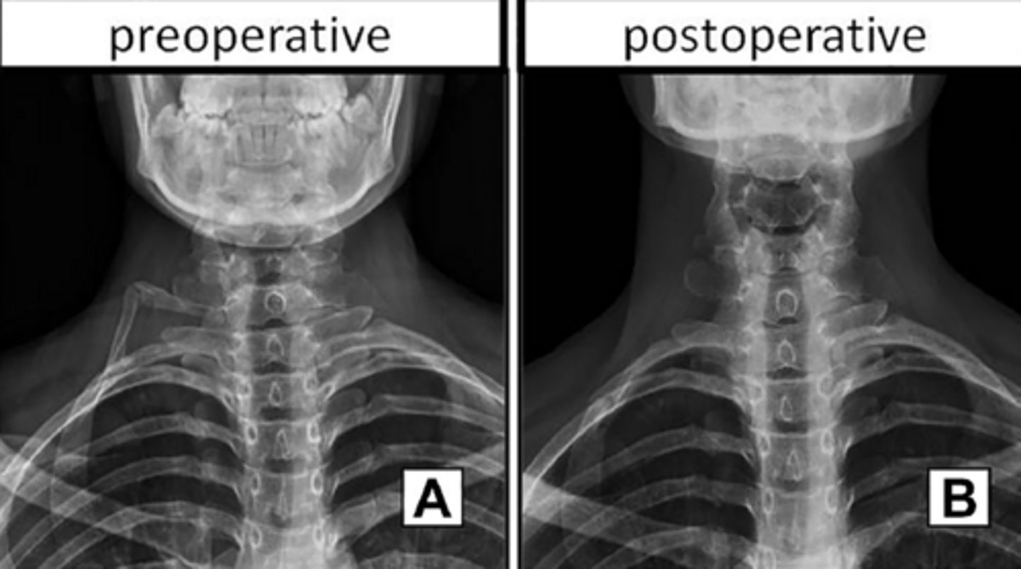 <p>Cervical and chest radiographs to identify cervical ribs, prominent C7 transverse processes, or masses.</p>