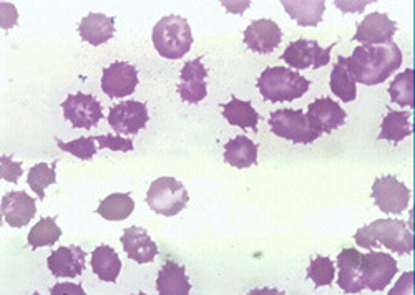 <p>ABETA LIPOPROTEINEMIA (BASSEN-KORNWEIG SYNDROME).</p><p>Peripheral blood smear will show abnormally shaped RBCs (acanthrocytes - spiked or crenated) and plasma lipid profile will show low cholesterol and TGs. Autopsy shows posterior column and spinocerebellar tract degeneration.</p><p>Initial complaints = lost position sense. Deficits accumulate over the course of ears.</p>