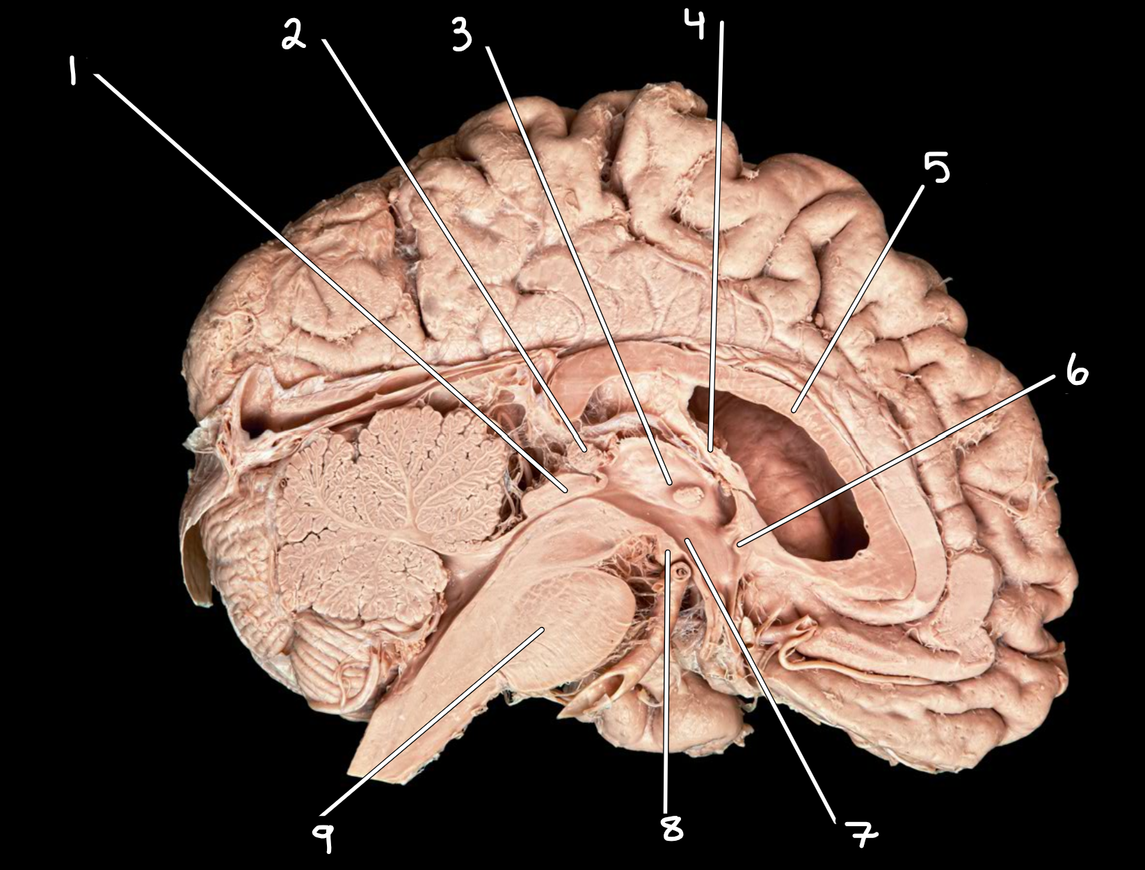 <p>Midsagittal brain: left side </p>