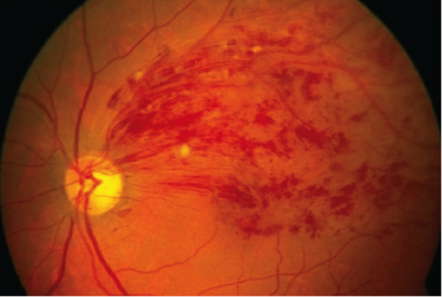 <p>occurs when thickened or <strong>hardened</strong> retinal arteries cross over a<strong> retinal vein</strong> and block it.</p><p></p><p>when the vein is blocked, nerve cells within the eye may <strong>die.</strong></p>