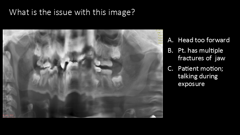 <p>What is the issue with this image?</p><p>A. Head too forward</p><p>B. Pt. has multiple fractures of  jaw</p><p>C. Patient motion; talking during exposure</p><p></p>