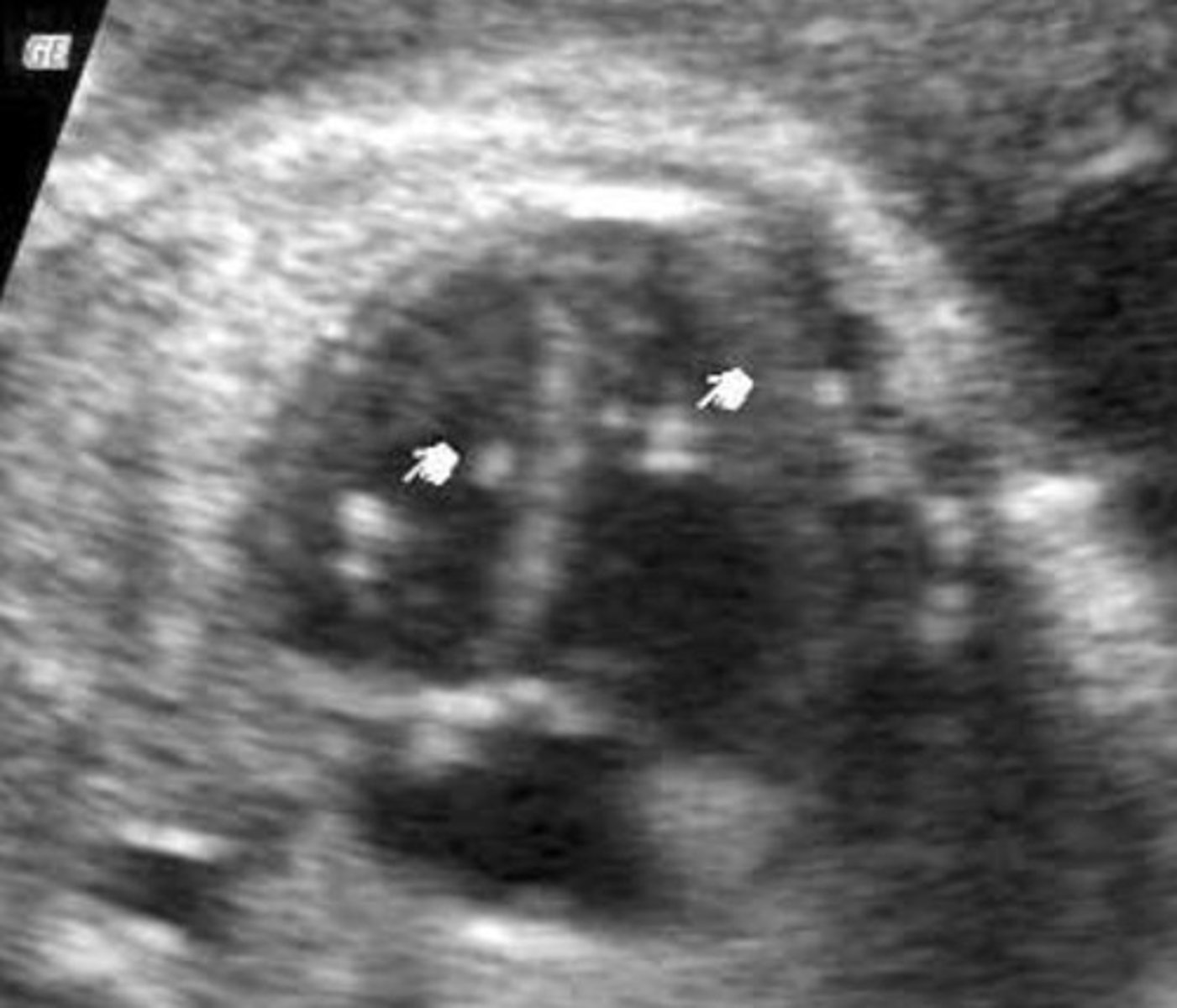 <p>Small echogenic area in heart</p><p>Usually in LV on papillary muscles or chordae</p>