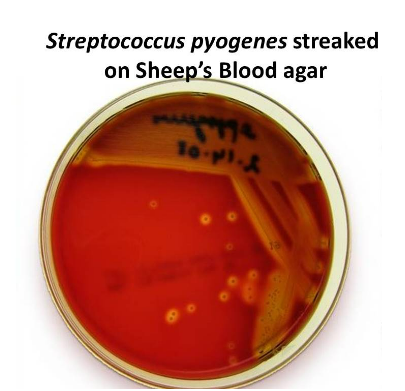 <p>Streptococcus pyogenes, the etiological agent of strep throat, scarlet fever and rheumatic fever, exhibits complete clearing of RBCs when grown on sheep's blood agar. What type of hemolytic pattern does this indicate?</p>