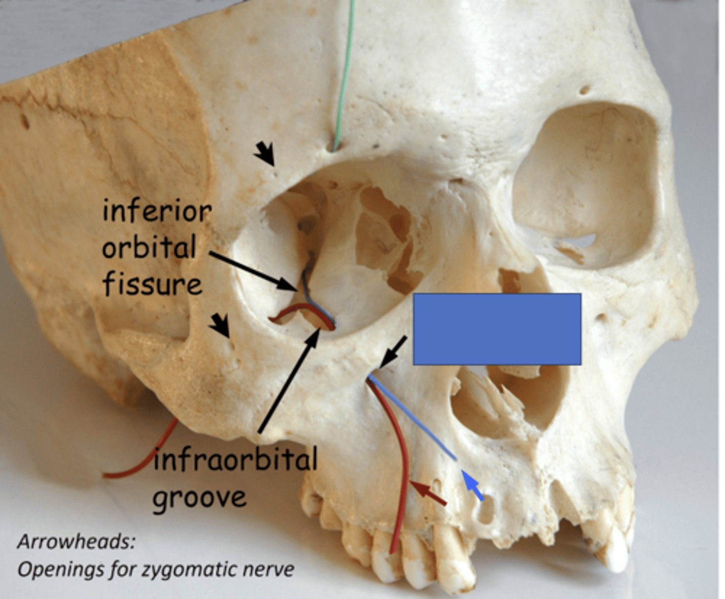 <p>the infraorbital nerve (ION) passes through the inferior orbital fissure, travels through the infraorbital groove and exits onto the face through the...</p>