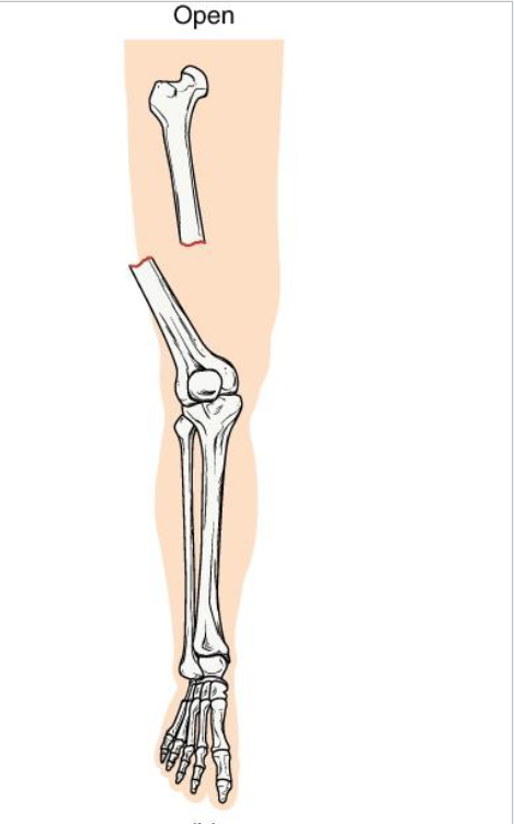 <p><strong>Definition:</strong> Bone <strong>breaks through the skin </strong>(or skin is broken, exposing bone)</p><p><strong>Mechanism: High-energy trauma </strong>(ex: motor vehicle accident, gunshot)</p><p><strong>Clinical note: High infection risk and delayed healing.</strong></p><p><strong>Key concept</strong>: Requires surgical cleaning and fixation</p>