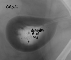 <p>mural diseases and intramural filling defects</p>