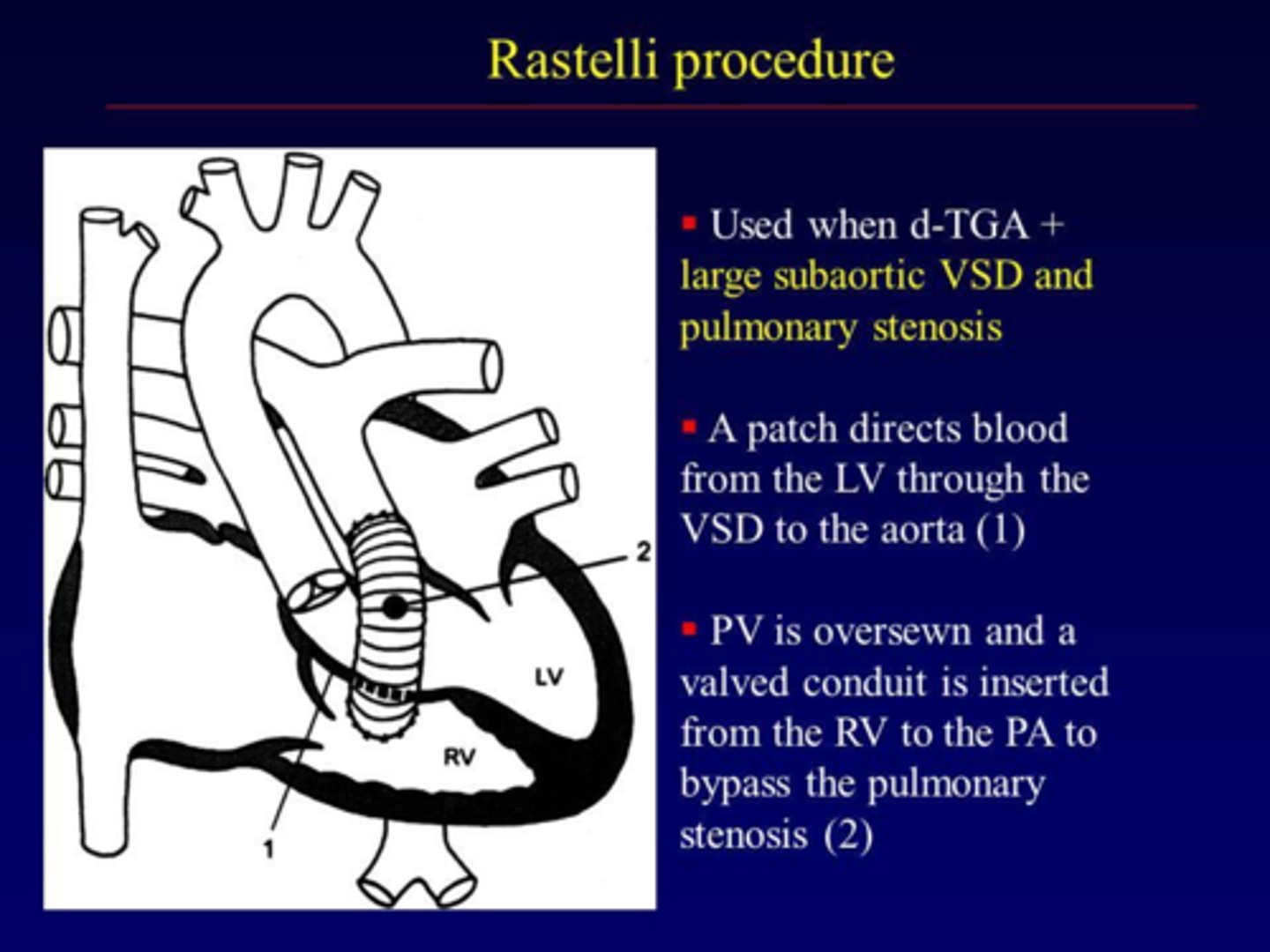 <p>Correction of transposition of great arteries</p><p>Aorta is rerouted internally to LV across VSD and pulmonary artery is attached to RV externally</p>