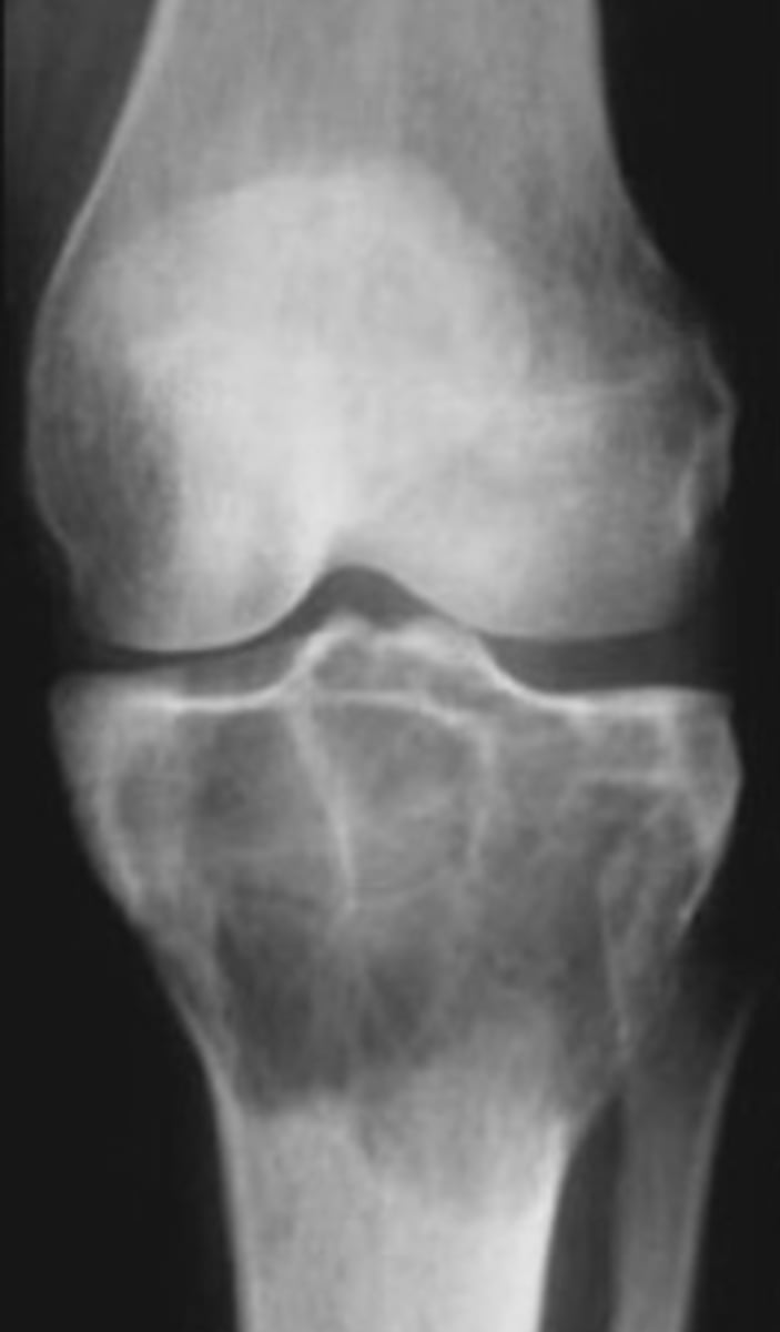 <p>Giant cell tumor pathology:</p><p>- _____ benign (F:M, 3:2)</p><p>- _____ malignant (M:F, 3:1)</p>