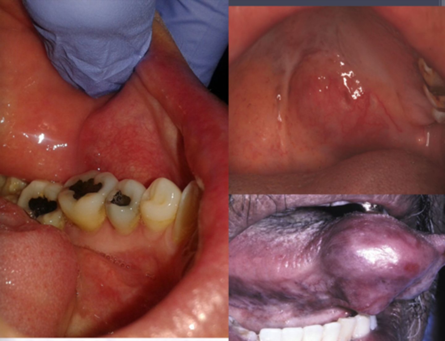 <p>Malignant Salivary Gland Tumors: </p><p>-Most common malignant salivary gland tumor</p><p>-Most common malignant salivary gland tumor in children</p>