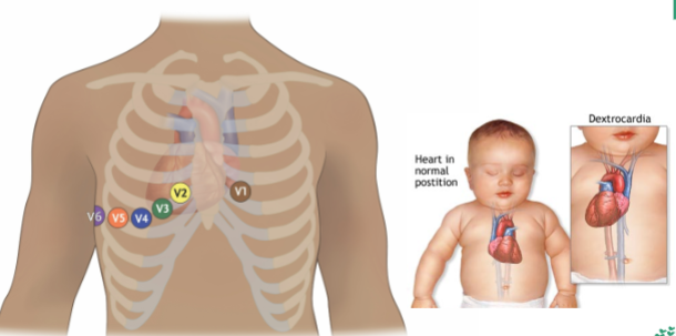 <p>a rare heart condition that causes the heart to develop pointing to the right side of the chest instead of the left side.</p>