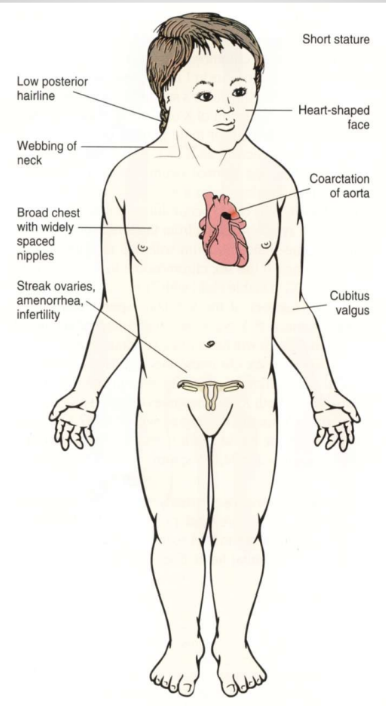 <p>Turner Syndrome (XO)</p>