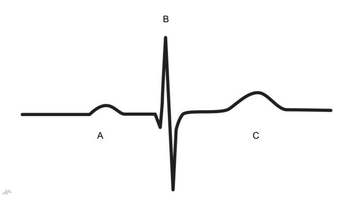 <p>What does A represent on the EKG?</p>