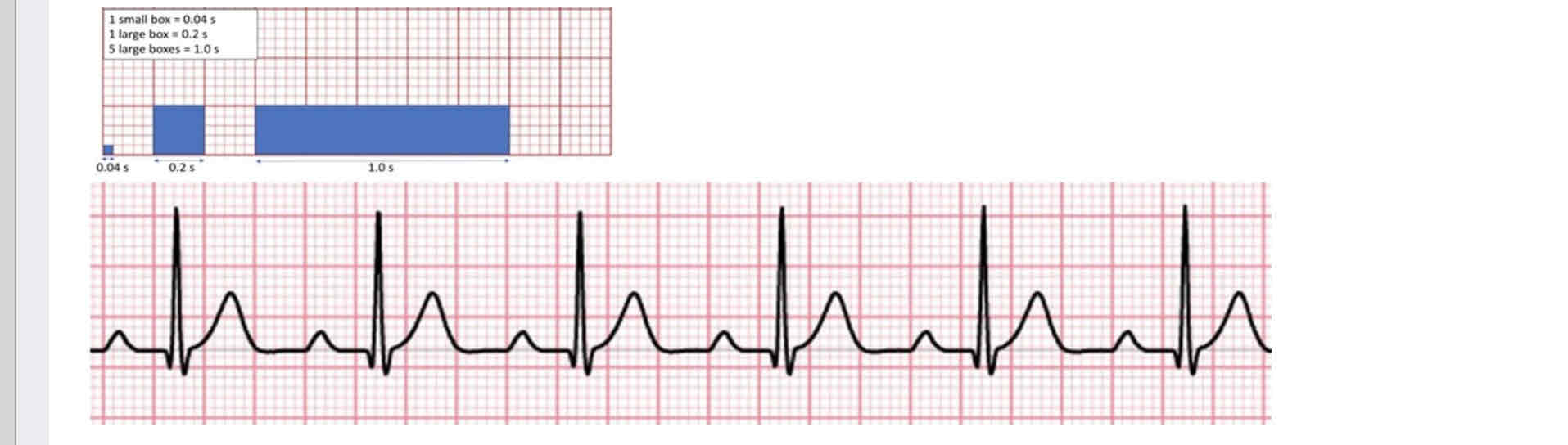 <p>What is the beat period for this patient? Round to the nearest 100th</p>