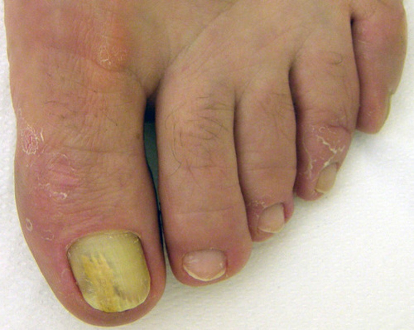 <p>thick, brittle, discolored nails</p>