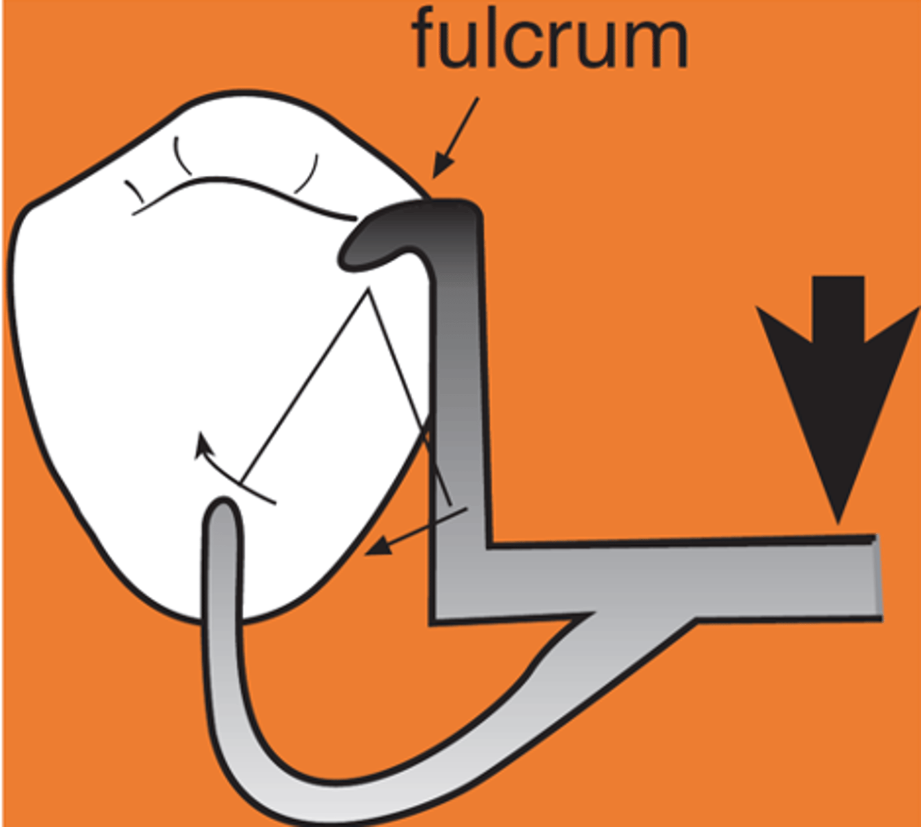 <p>Distal occlusal rest on tooth adjacent to distal edentulous segment</p><p>• Rotation: retentive tip, proximal plate</p><p>• Move mostly forward (tip rotates up)</p><p>• Toward height of contour (activate or bind)</p>