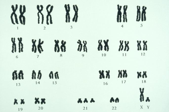 <p>a visual representation of an individual's complete set of chromosomes, allowing doctors to analyze the number and structure of chromosomes to identify potential genetic abnormalities, including trisomy, where an individual has an extra copy of a specific chromosome, appearing as three copies instead of the usual two in a pair; on a karyotype, trisomy is easily identifiable by seeing three distinct copies of a particular chromosome instead of just two</p>