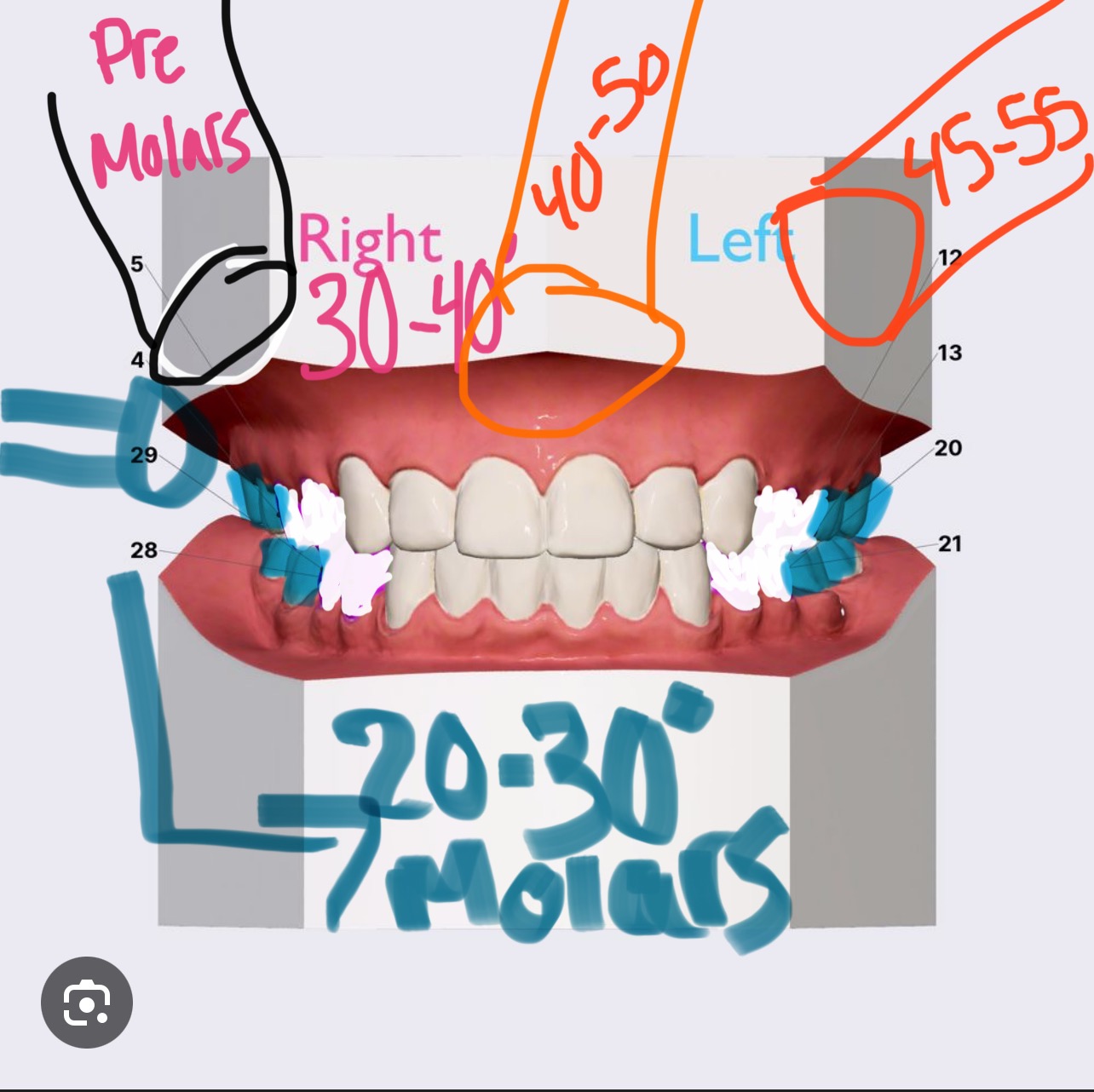 <p>What is the correct vertical angulation for maxillary molars when using the bisecting technique?</p>