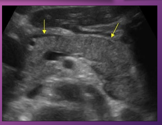 <p>In the early stages of _____ pancreatitis, the sonographic appearance of the gland may _____ show _______ on sonography. </p>