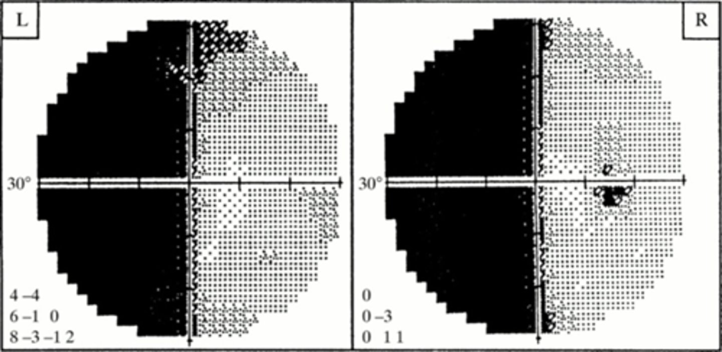<p>What VF defect is present DURING a migraine attack?</p>
