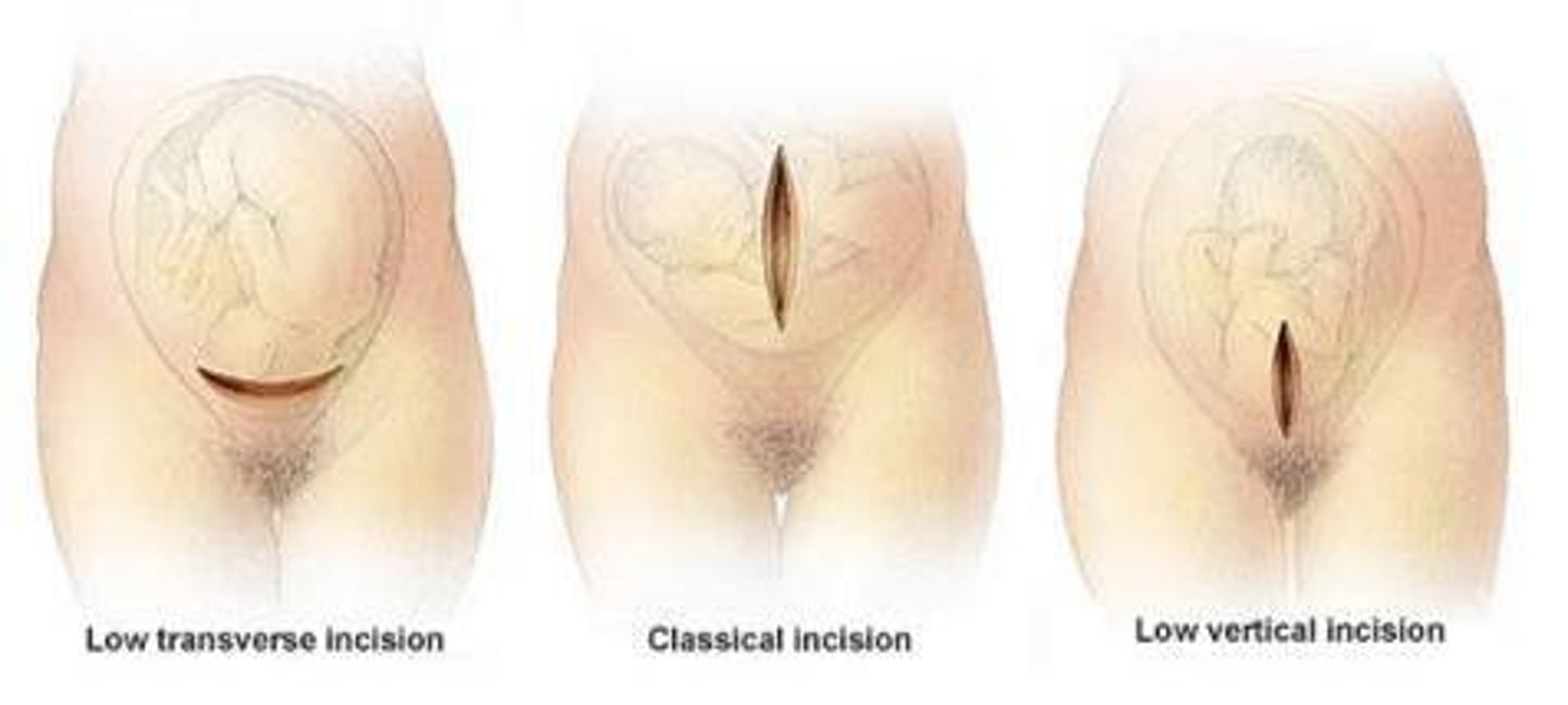 <p>incision into the uterus</p>