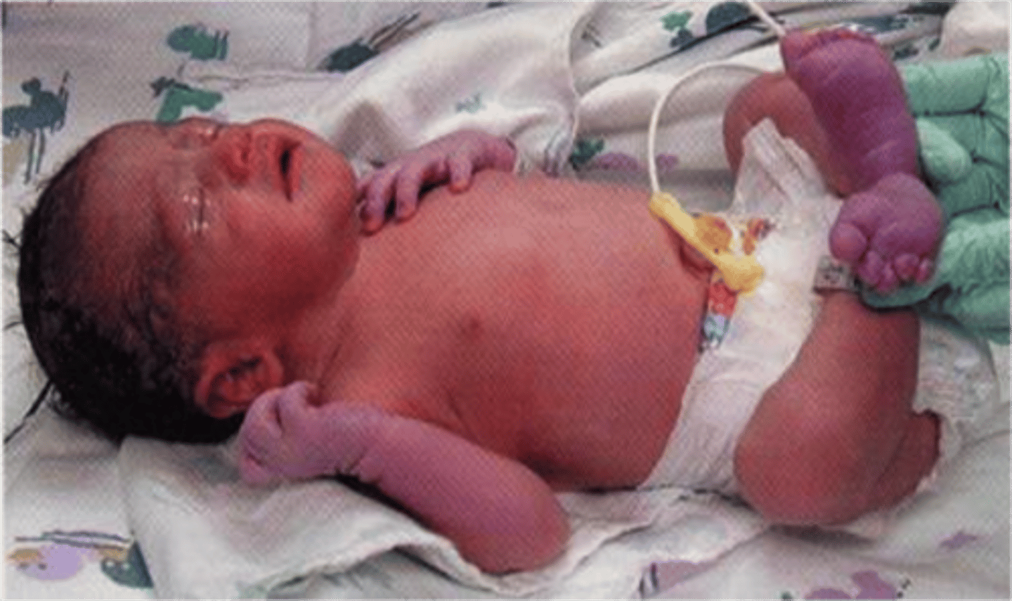 <p>Bluish discoloration of the hands and feet</p>