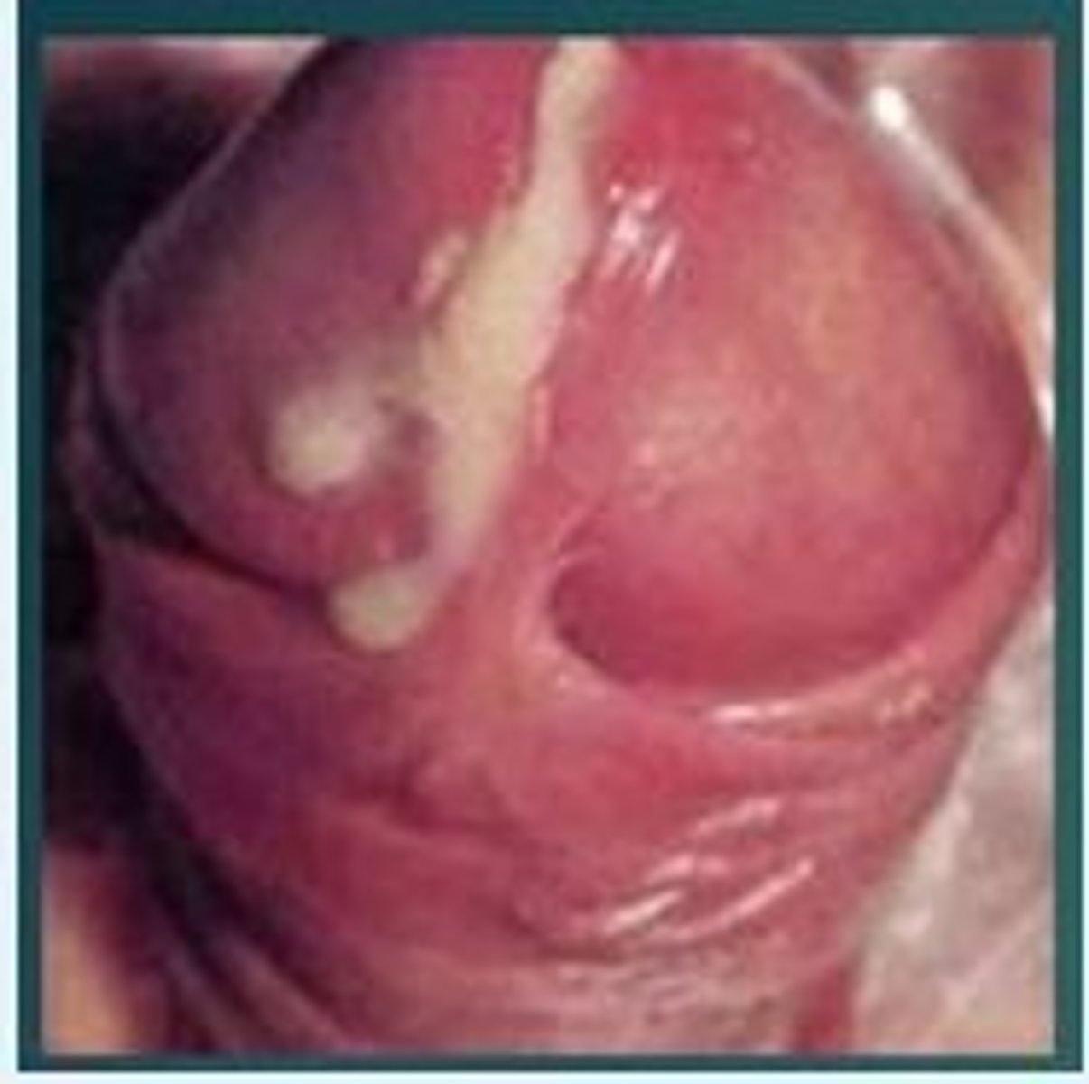 <p>c) Gonorrhea</p>