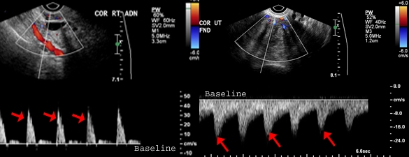 <p>What phase of vascular flow does the red arrow indicate?</p>