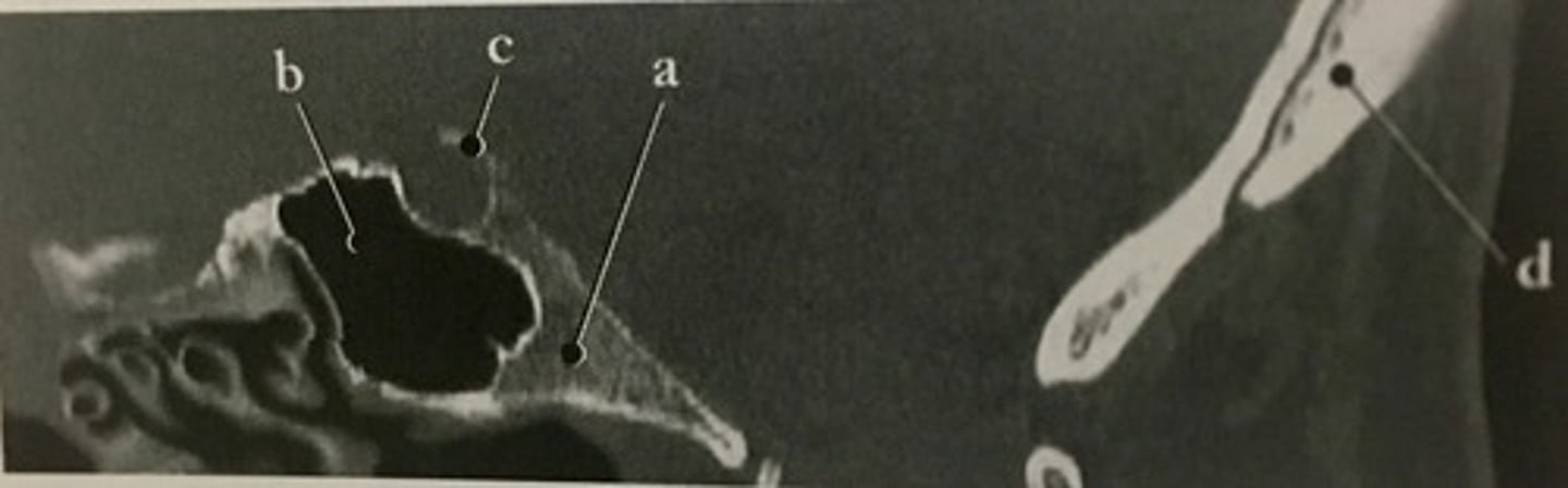 <p>Identify structure B on this sagittal reformat of the occipital bone.</p>