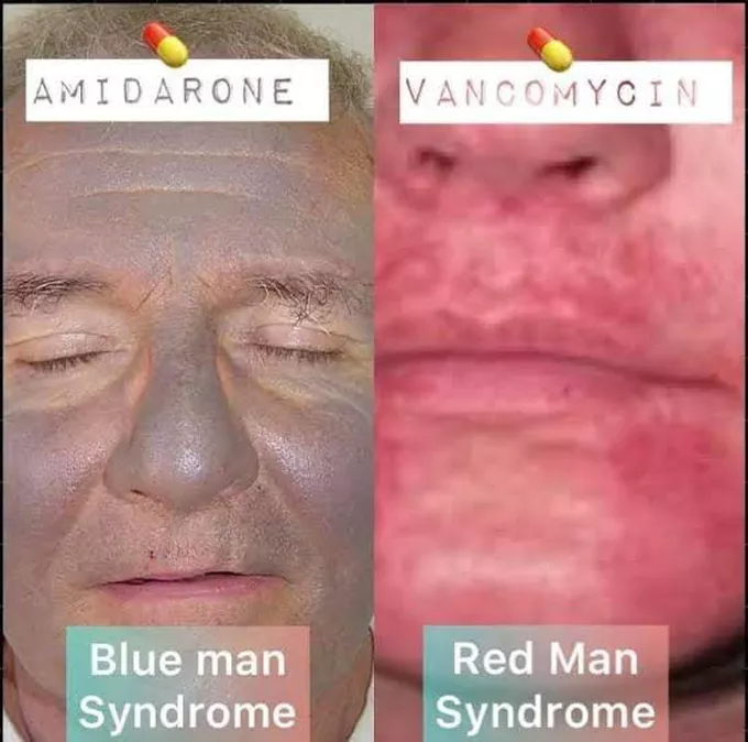 <p>b) Red man syndrome</p><div data-type="horizontalRule"><hr></div><ul><li><p><strong>Red man syndrome</strong> is a histamine-mediated reaction → flushing, rash on the face, neck, and upper torso.</p></li><li><p>It’s NOT an allergy → it’s due to rapid IV infusion.</p></li><li><p>Slow the infusion rate and premedicate with antihistamines to prevent it.</p></li><li><p>Vancomysin can be a treatment to Pseudomembranous collitis (antibiotic-induced disease)</p></li></ul><p></p>