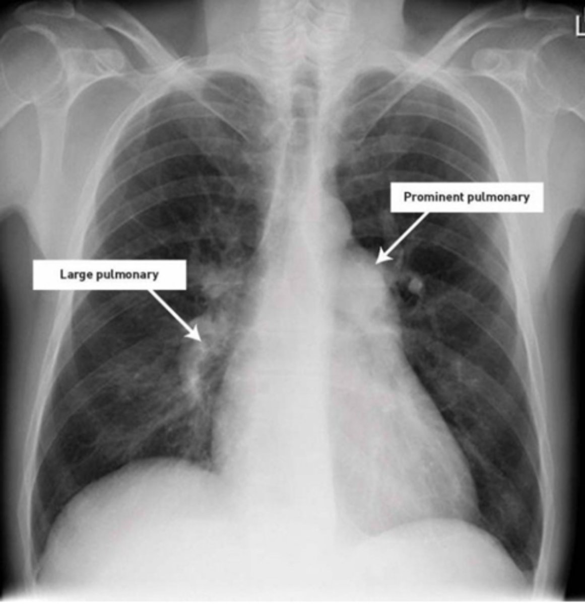 <p>enlarged pulmonary arteries</p>