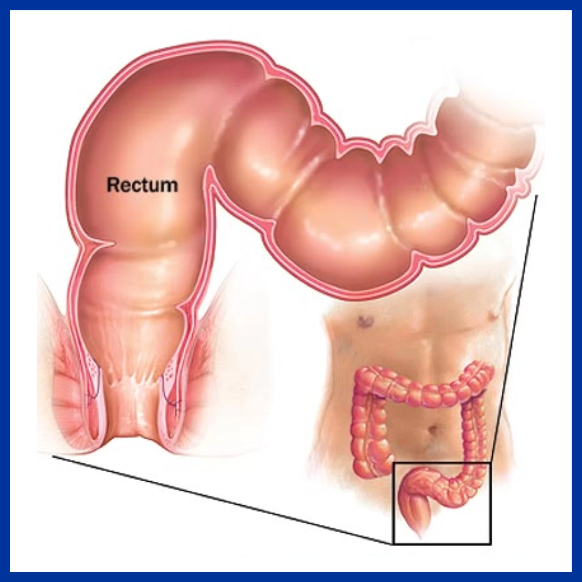 <p>The <strong><em><em></em></strong><strong></em></strong> is the final section of the large intestine that leads to the anus.</p>